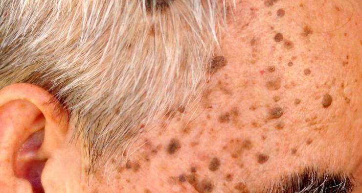 skin